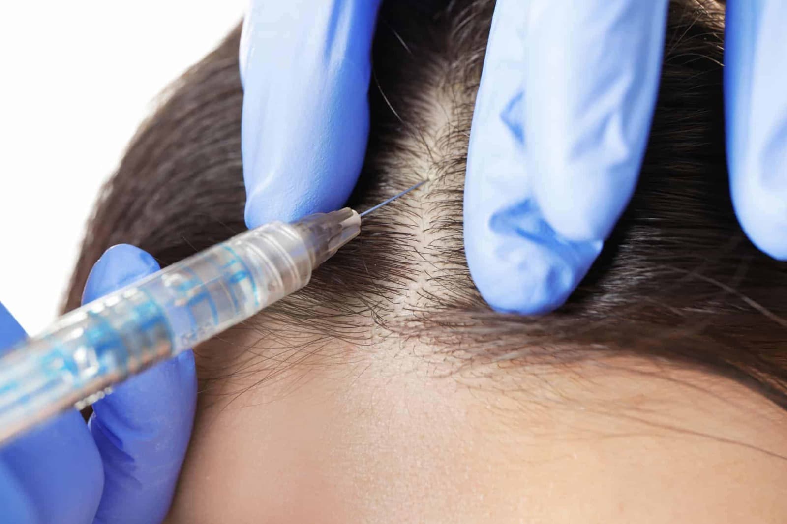 Hair Transplant – The Ultimate Solution for Hair Loss