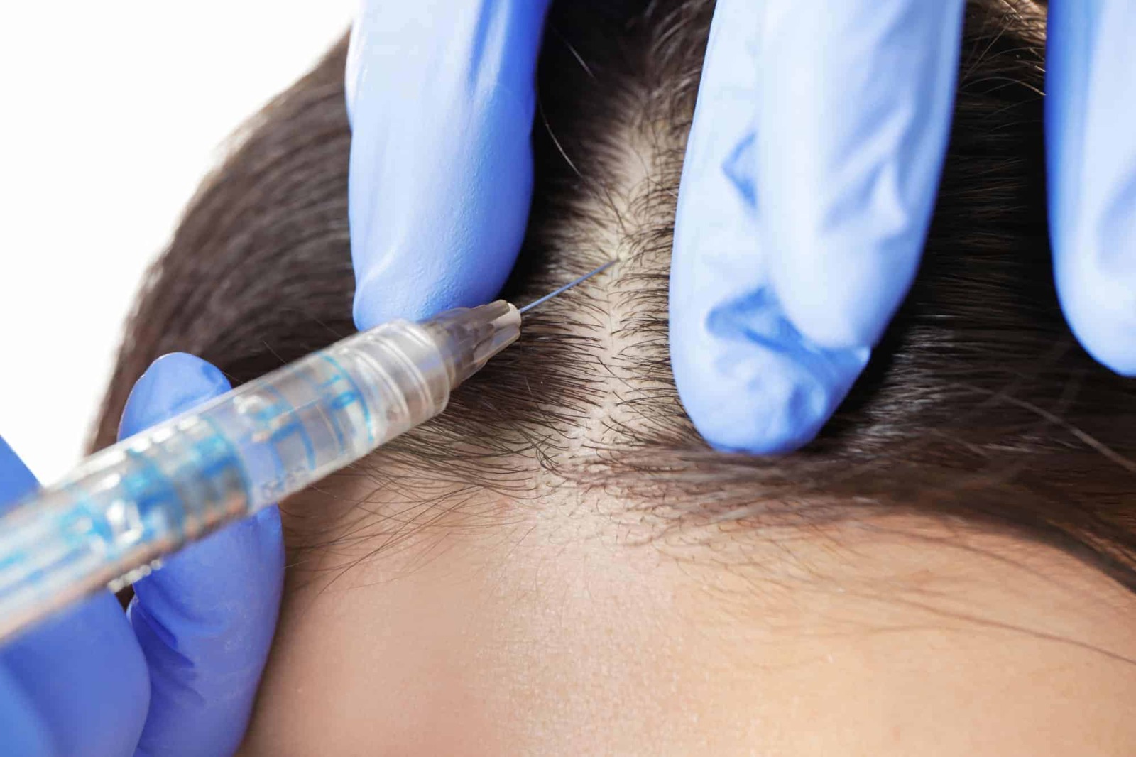 Hair Transplant – The Ultimate Solution for Hair Loss