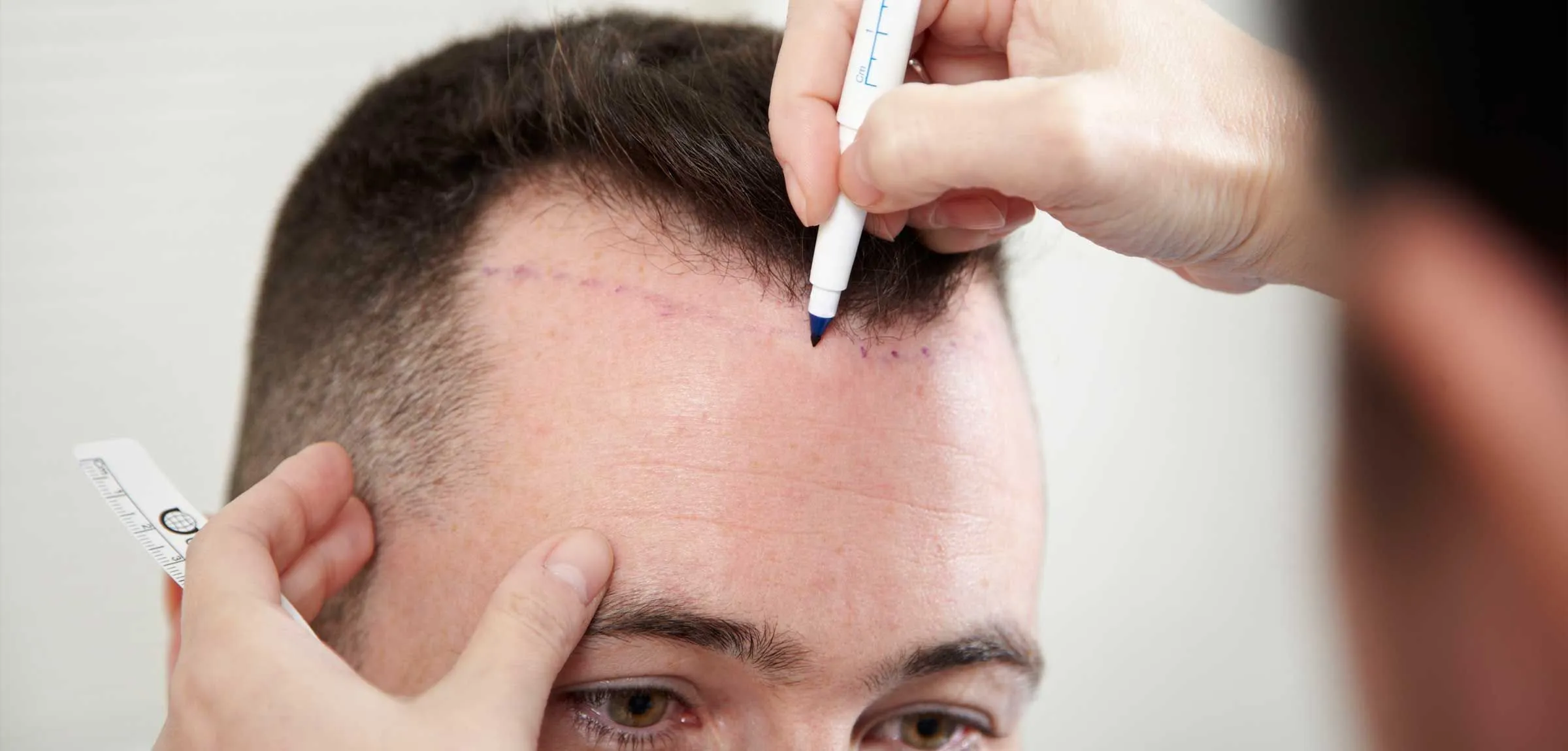 Hair Transplant UK – Combining Artistry and Medical Precision